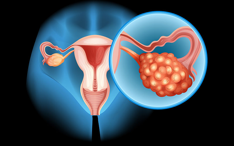 The Science of Amniotic Tissue in Prostate Cancer Surgery